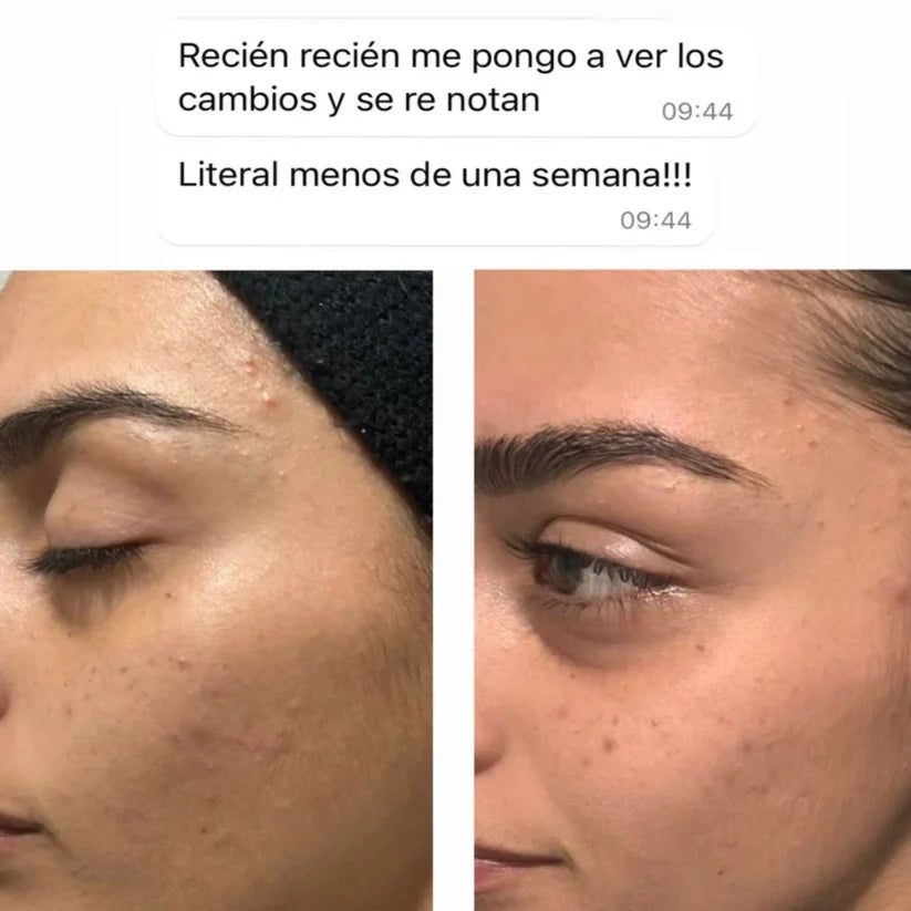 CLEAR ADVANCE® | Suplemento Anti Acné