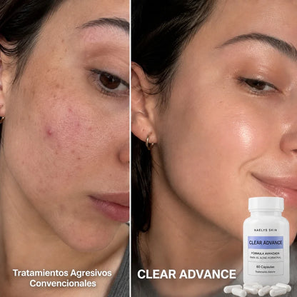 CLEAR ADVANCE® | Suplemento Anti Acné